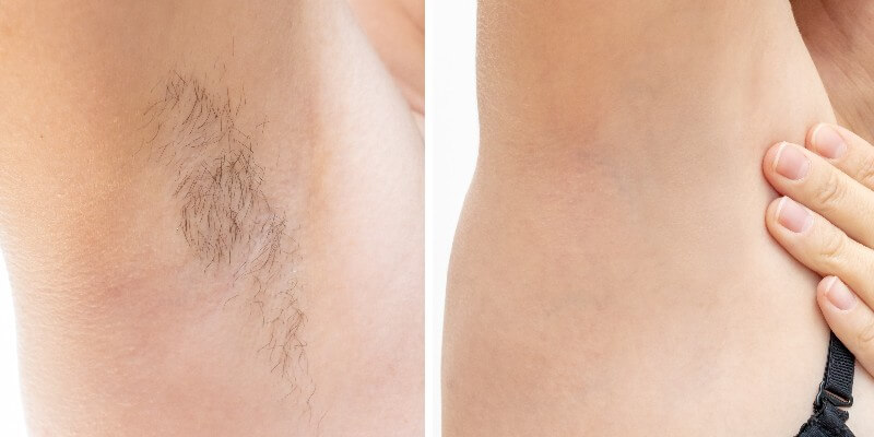 Underarm Laser Hair Removal For Lisa