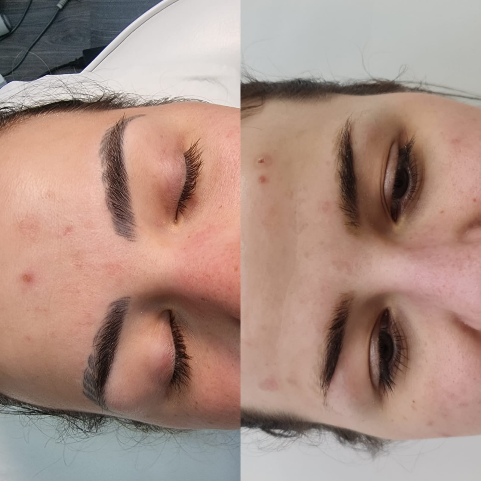 Victoria's Experience of Cosmetic Laser Tattoo Removal - Bianco Beauty